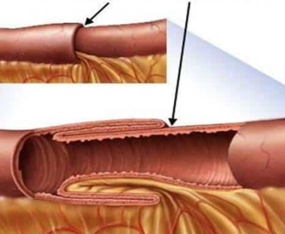 Các phương pháp điều trị lồng ruột